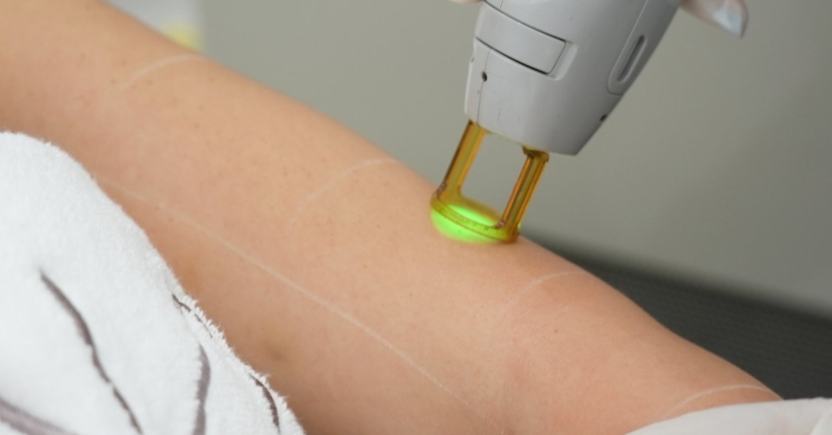 Laser Hair Removal Appointment
