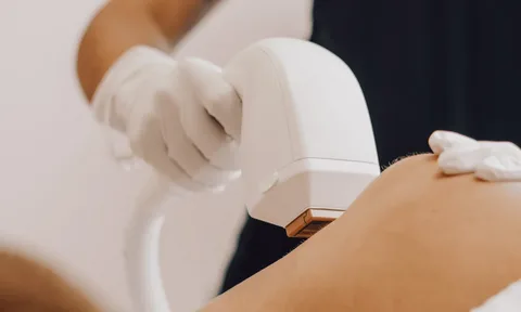 Permanent laser hair removal